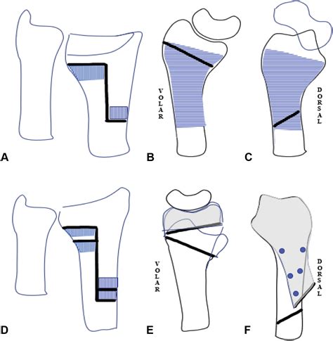 Z Corrective Osteotomy In Malunited Extra Articular Fractures Of Distal