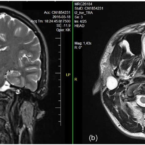 A B T1 And T2 Weighted Mri The Left Mastoid Showed Hyperintense Download Scientific Diagram