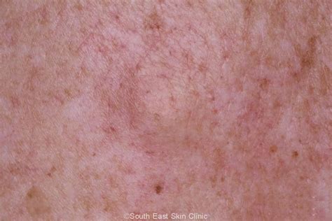 Sebaceous Cyst South East Skin Clinic