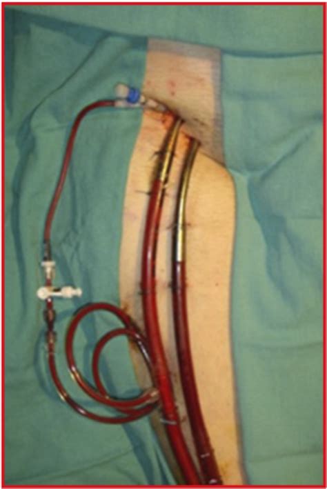 Resuscitative Extra-Corporeal Life Support (ECMO) in the ED