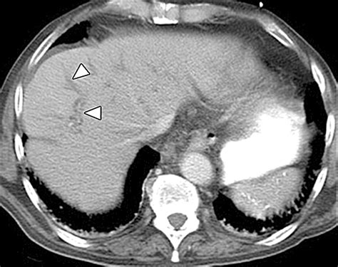 Cross Sectional Imaging Of Acute And Chronic Gallbladder Inflammatory