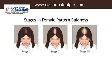 What Kind Of Stages In Female Pattern Baldness Cosmo Hair Hair