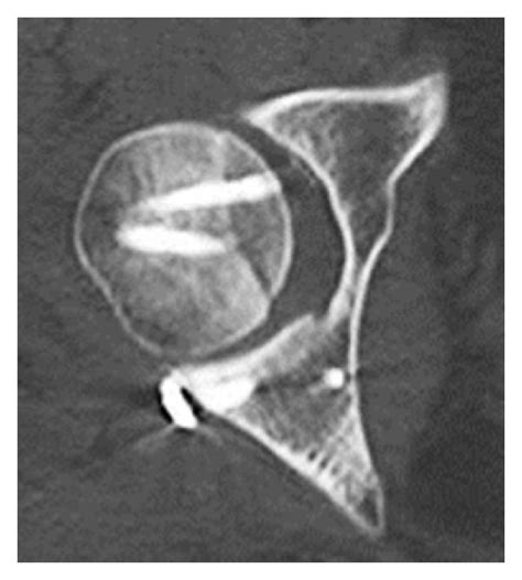 Case 1 A Anteroposterior X Ray Image Of The Right Hip After Open