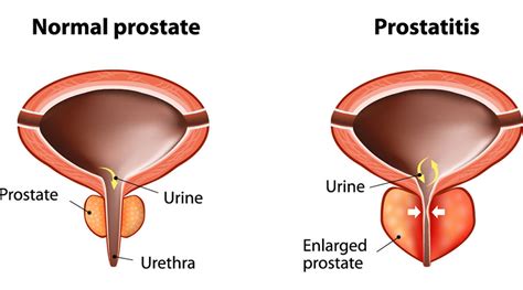 Chronic Prostatitis :Background, Types ,Symptoms & Treatment - Thwaini