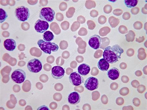 Leucemia Linfoc Tica Cr Nica Edulabc