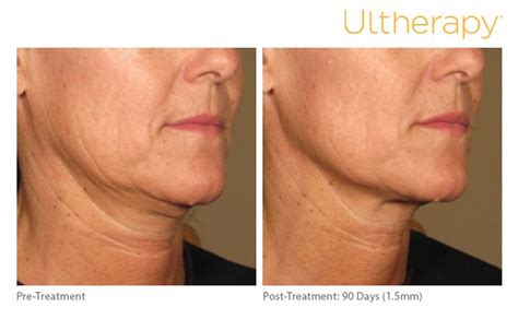 Ultherapy Edmonds Ultrasound Skin Tightening Wrinkle Smoothing In