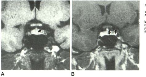 Figure 2 From Gd DTPA Enhanced MR Imaging Of Pituitary Adenomas