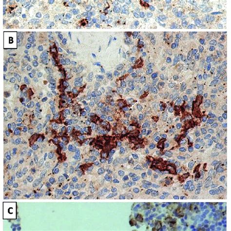 microphotographs   cleca positive human tonsil controls
