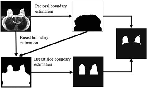 Automatic Segmentation Of Mri In Prospective Breast Volume Evaluation