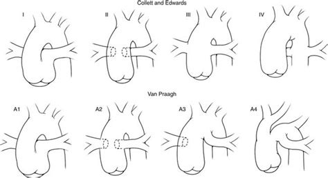 Truncus Arteriosus And Aortopulmonary Window Thoracic Key