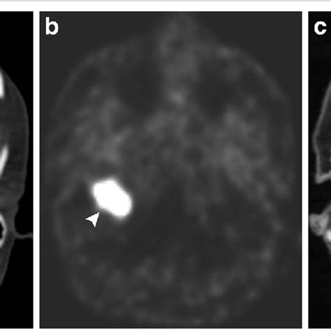 Axial Ct A Demonstrates Widening Right Jugular Bulb With A