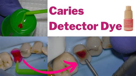 Is Caries Detector Dye BS Caries Removal Investigated PDP138 YouTube