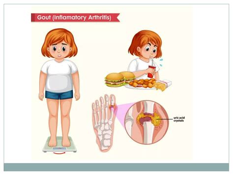 Drugs for Gout ( Acute and Chronic gout) | PPTX