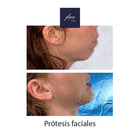 Pacientes con prótesis faciales antes y después Face Clinic