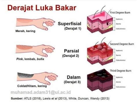 Derajat Keparahan Luka Bakar dan Cara Mengukurnya | Kredit Pintar