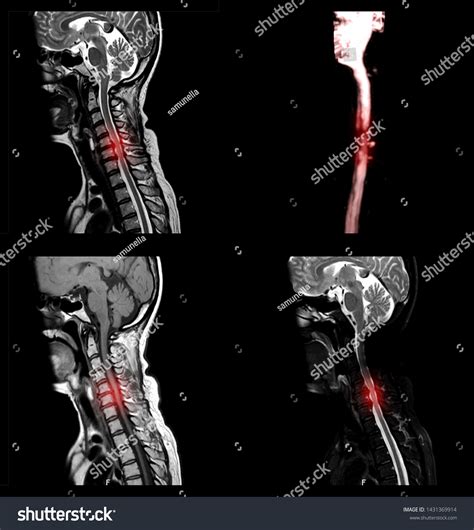 65 Symptoms Cervical Vertebrae Compression Images, Stock Photos