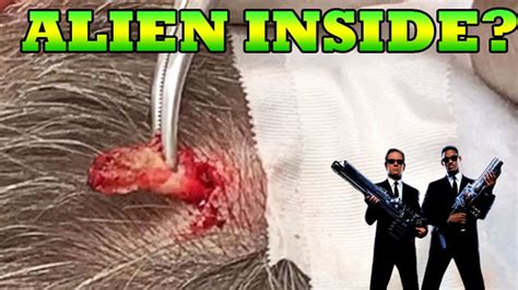 Alien Scalp Cyst Whats Insidecysts And Pimple Pops Pimple Popping