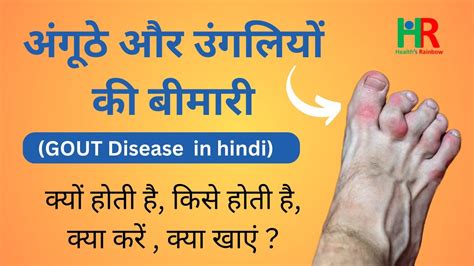 Gout Symptoms Causes Diagnosis Treatment And Diet अंगूठे और उंगलियों