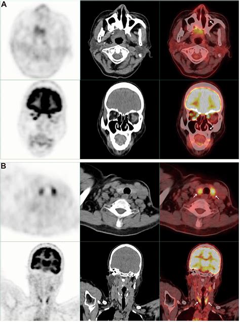 Frontiers Situs Inversus Totalis On F Fdg Pet Ct A Case Report And