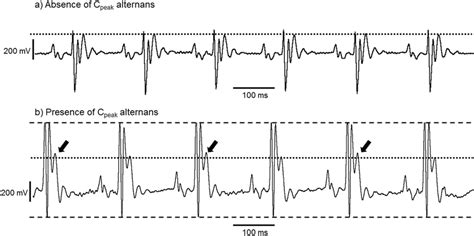 Representative Ecg Traces To Show The Absence A And Presence B Of C