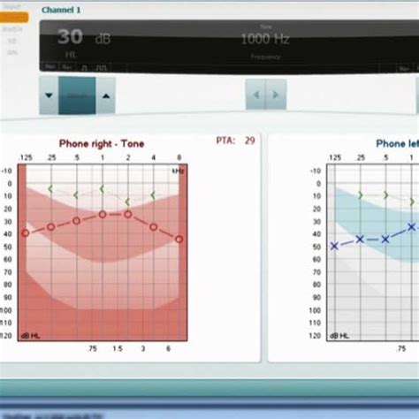 Tympanogram -bilateral B type curve, with severe Eustachian tube... | Download Scientific Diagram