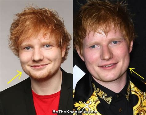 Ed Sheeran Plastic Surgery Comparison Photos