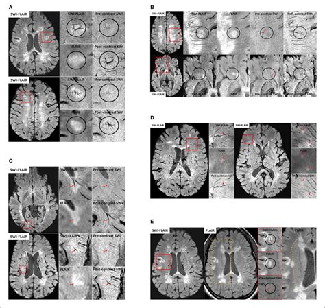 Figure 3 From An Overview Of Venous Abnormalities Related To The