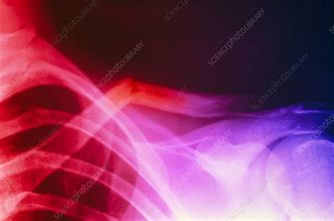 Col X-ray image showing a fractured clavicle - Stock Image - M330/0436 ...