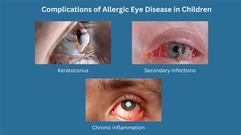 allergic eye disease  children
