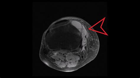 Knee Mri Anteromedial Tibia Ganglion Cyst Youtube