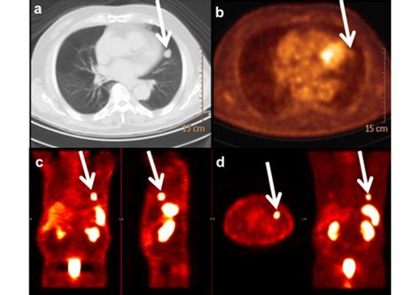 Axial A Mdct With Lung Window Demonstrates A Well Defined Nodule Of