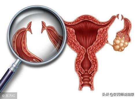 婦科腫瘤，我們要認識它別害怕 每日頭條