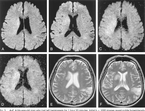 Figure 2 From Imaging Of Hyperacute Ischemic Stroke At High B Value