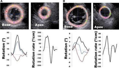 Left Ventricular Twist And Torsion Circulation Cardiovascular Imaging