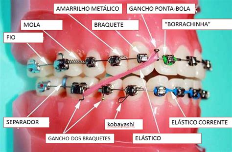 Ortodontia Arte E Se Eu Faltar S Consultas De Manuten O Do