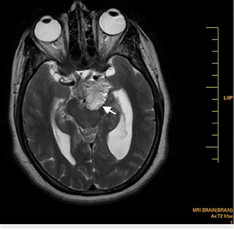 Figure 1 From Magnetic Resonance Imaging Findings In A Rare Case Of A