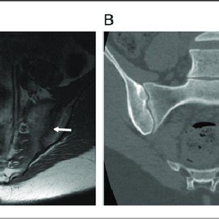 21-year-old female with dedicated Sacroiliac joint MRI and CT. (A) MRI ...