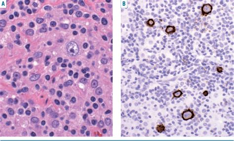 T Cell Histiocyte Rich Large B Cell Lymphoma Semantic Scholar