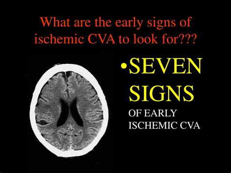 PPT - CT HEAD and ISCHEMIC CVA What to look for on the early scan?? PowerPoint Presentation - ID ...