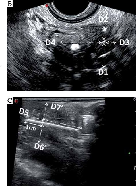 Figure From Application Of Transrectal Ultrasound In Guiding