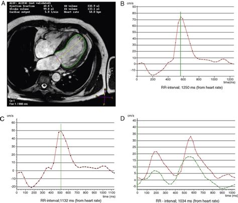 Analysis Of Left Ventricular Diastolic Function Using Magnetic