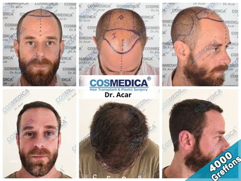 Fue 4000 Grafts Baldness Restoration