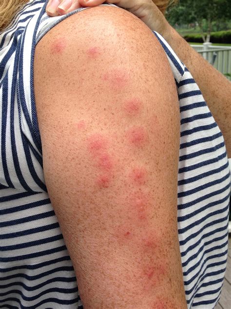 Identify Bug Bites On Humans Nbkomputer