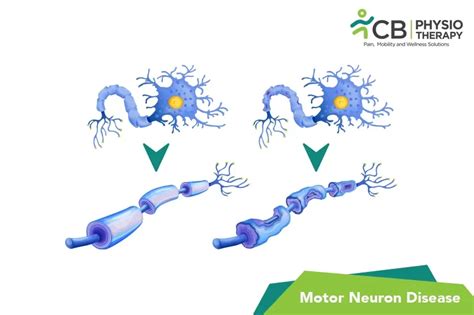 What Is Motor Neuron Disease MND Symptoms Causes Diagnosis