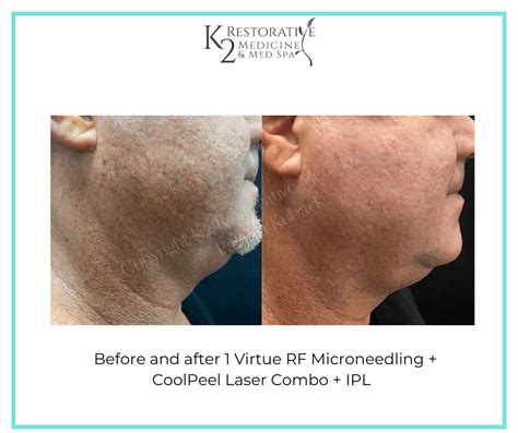 Experience Skin Revitalization With Virtue Rf Microneedling