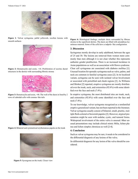 Syringoma | PDF