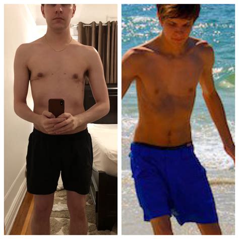 Pectus Excavatum Causes Figure 2 From Pectus Excavatum From A