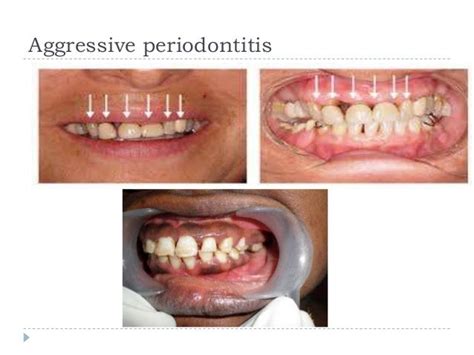 Aggressive Periodontitis 3