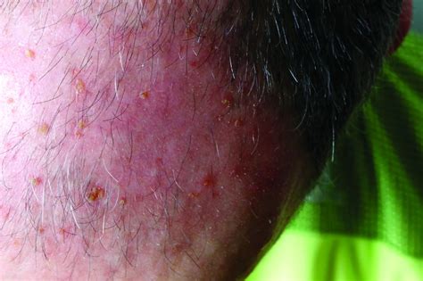 Fluorouracil Beats Other Actinic Keratosis Treatments In Head To Head Trial Mdedge Dermatology