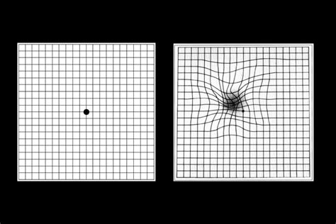 Test Di Amsler A Cosa Serve La Griglia Per La Degenerazione Maculare